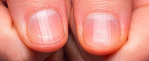 healthy nails: solve & achieve common nail concerns | essie