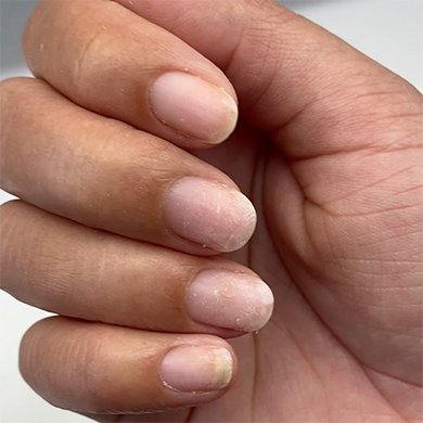 Medium skin hand with fingers folded toward palm showing damaged nails with ridges